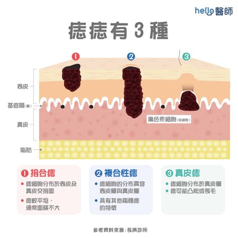 身體上的痣|痣變大、痣多或長毛會變皮膚癌？認識痣的形成與原因